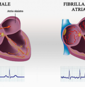 '' Il cuore e dintorni  -  Fibrillazione atriale - Diagnosi e terapia ''
